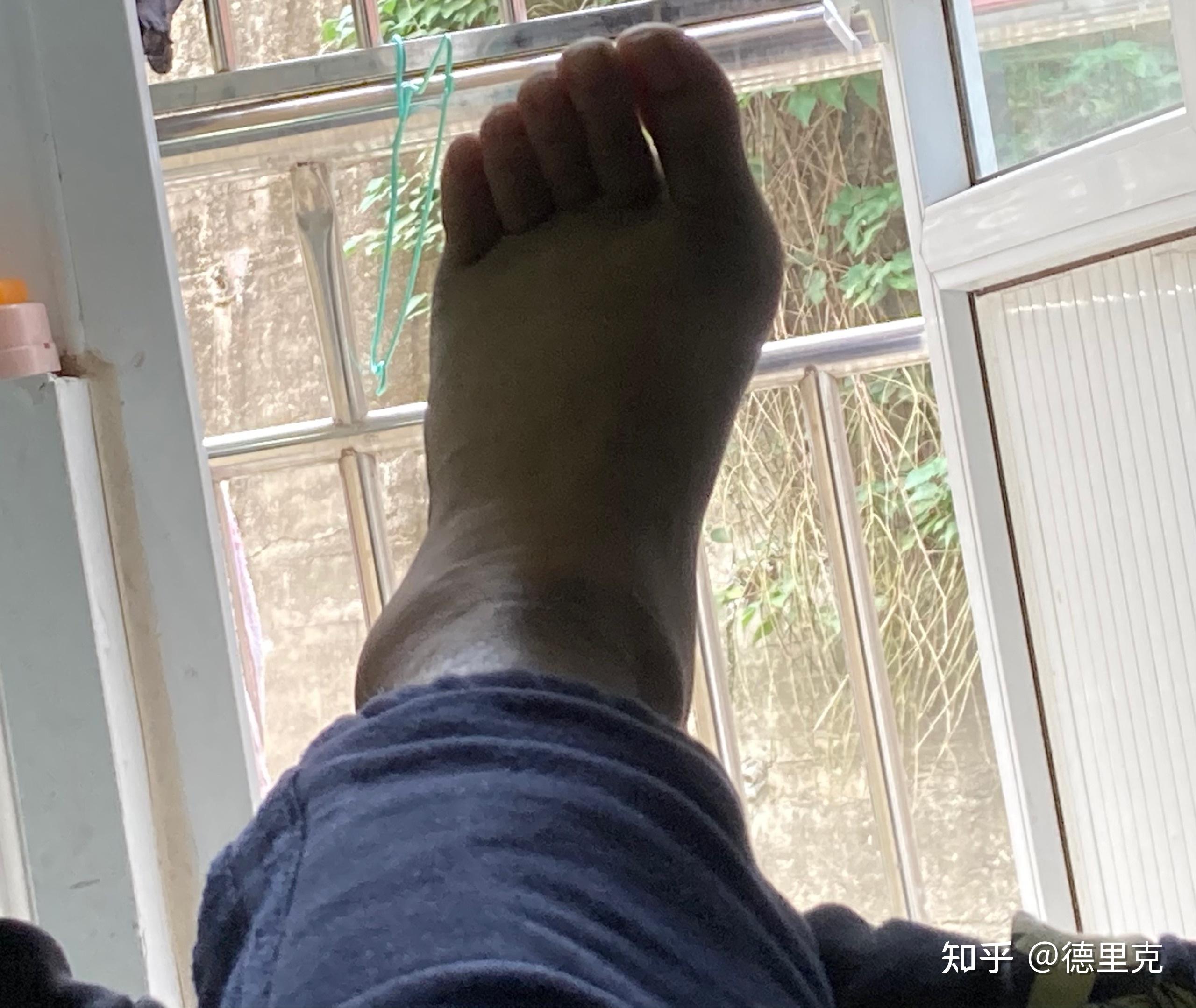 云达不莱梅前锋脚踝受伤，愈后康复缓慢